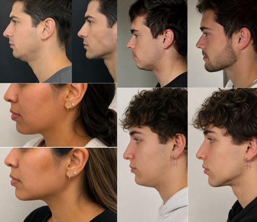 Nasal Strips